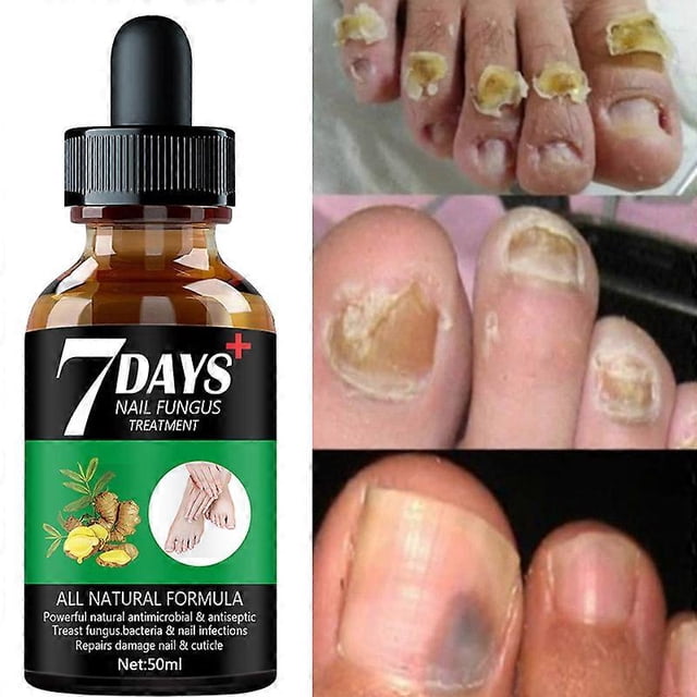 7DAYS Tratamiento de hongos en las uñas Esencia Suero Cuidado Cuidado de manos y pies Eliminación Gel reparador Antiinfeccioso