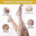 thumbnail image 3 of 60g Bee-venom Anti-varicose Soothing Cream, Advanced Vitamin K Cream Reduces Swelling Varicose Spider Veins, 3 of 5