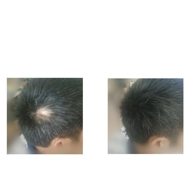 Tebru Hair Building Fibers Comb Hair Loss Concealer Powder Hairline Comb Hair  Regrowth Fiber Guidline 