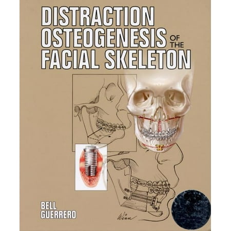 UPC: 9781550093445 | Pre-Owned Distraction Osteogenesis of the Facial Skeleton (Hardcover) by William H Bell