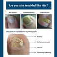 thumbnail image 4 of Toenail Fungus Treatment Extra Strength: Antifungal Cream, Athletes Foot Treatment Cream, Jock Itch Cream, Antifungal Treatment for Athletes Foot, 4 of 6