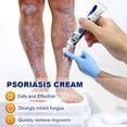 thumbnail image 4 of Ungüento para Psoriasis, Dermatitis, Eczema, alivia las alergias de la piel, pomada para prurito de la piel de manos y pies, 1-3-5 Uds., 4 of 4
