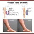 thumbnail image 4 of Parche de yeso para masaje de venas varicosas, hinchazón de piernas, lombriz de tierra, parche analgésico para masaje de venas de piernas Tw | 7389573809504, 4 of 5