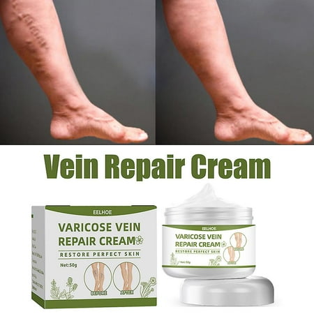 Varicose Veins Treatment Cream Spider Vein Treatment Cream Leg Repair ...