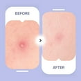 thumbnail image 2 of Maskeraide, Hydrocolloid Acne Patch, Acne Spot Treatment, Clear Pimple Patches, Spotted Nighttime, 2 of 5