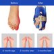 thumbnail image 5 of Corrector de juanetes Separador de dedos Corrección Hallux Valgus dedo gordo del pie alivi Abanopi Corrector de juanetes, 5 of 5