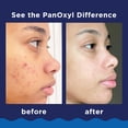 thumbnail image 4 of Limpiador facial PanOxyl Acne Foaming con peróxido de benzoilo 10% 90 ml, 4 of 7