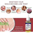 thumbnail image 4 of 1-3pcs Fungal Nail Treatment Highly Effective Kill Nail Fungus For Best Result, 4 of 5