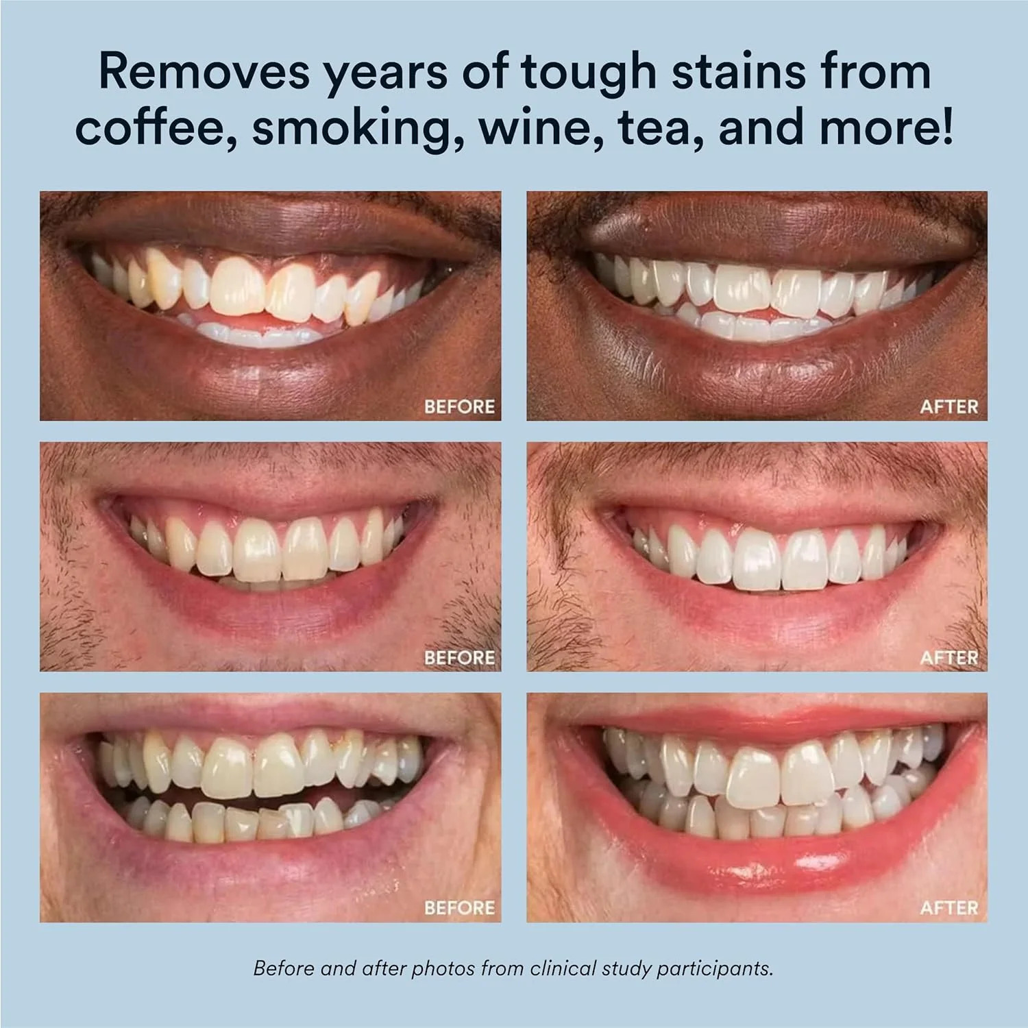 Auraglow LED Teeth Whitening Kit With 35% Gel, 20+ Treatments photo 4