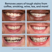 Auraglow Teeth Whitening Kit with LED Light, 35% Carbamide Peroxide Gel, 20+ Whitening Treatments, (2) 5mL Whitening Gel Syringes