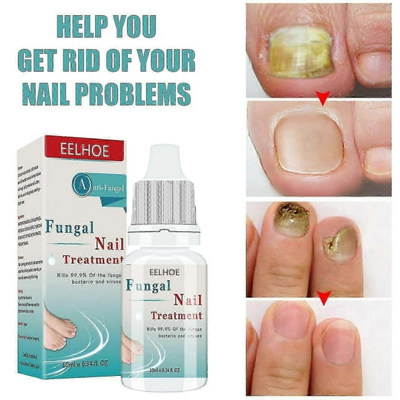 1pc Fungal Nail Treatment Liquid Nail Repair Moisturizing Anti-bag Nursing Liquid