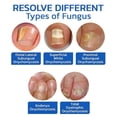 thumbnail image 4 of Dispositivo láser para hongos en las uñas, terapia de luz, onicomicosis, tratamiento de dedos de los pies, recargable, 4 of 5