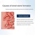 thumbnail image 2 of Electronic Tonsil Stone Remover Vacuum, Tonsil Stone Removal Kit, Instant Suction Tonsil Stone Remo, 2 of 5