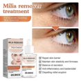 thumbnail image 3 of Milia Remover - Dissolve & Reduce Milia, Whitehead, Sebaceous Hyperplasia - 30ml, 3 of 5