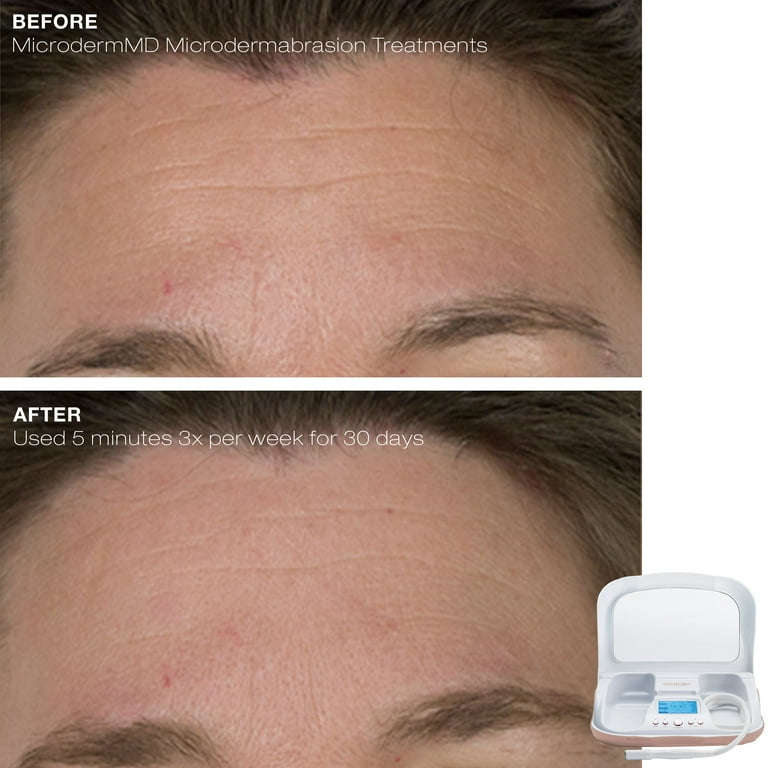 Trophy Skin MicrodermMD - Home Microdermabrasion Machine
