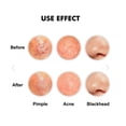 thumbnail image 3 of Relumins Kit Extracteur d'Imperfections 5 Pcs avec Boîtier en Métal, 3 of 3