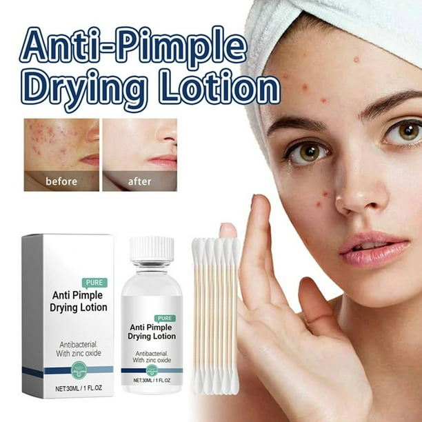 Fiudx Loción Secante para Granos, Tratamiento Eficaz Contra El Acné, Fórmula Exfoliante Nocturna, Nutrición Suave para Piel con Imperfecciones, Tratamiento Localizado, para Adultos con Piel Propensa