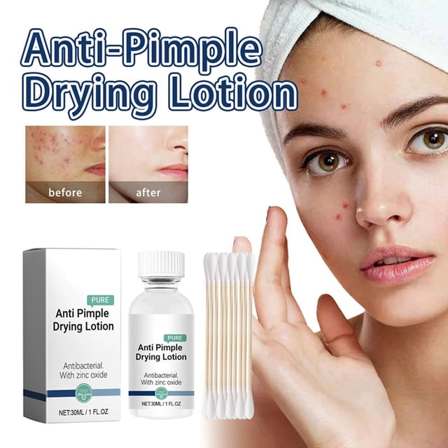 Fiudx Loción Secante para Granos, Tratamiento Eficaz Contra El Acné, Fórmula Exfoliante Nocturna, Nutrición Suave para Piel con Imperfecciones, Tratamiento Localizado, para Adultos con Piel Propensa