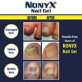 Nonyx Nail Gel Before And After Nonyx Fungal Nail Clarifying Gel - Rids Toenails of Fungus by Removing