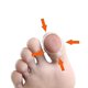 thumbnail image 2 of Ingrown Toenail Corrector Nail Ingrown Toenail Ingrown Toenail A, 2 of 3