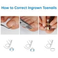 thumbnail image 4 of NiHome 14-In-1 Nail Care Set for Thick and Ingrown Nails for Men, Women, Seniors, Heavy-Duty Toenail Clipper Kit with Travel Case, Stainless Steel Trimmer, Dual Spring Cutter with Non-Slip Handle, 4 of 10