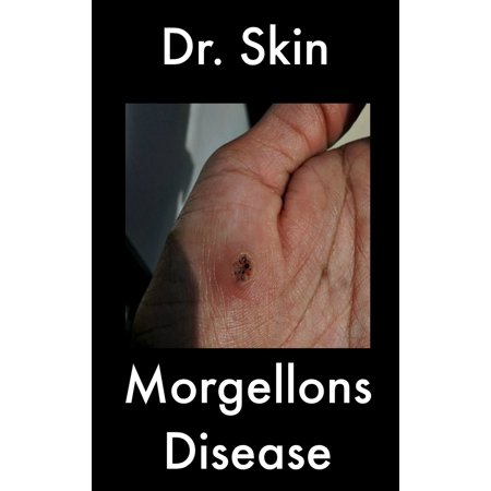 Morgellons Disease - eBook