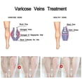 thumbnail image 4 of Vova Crema Varices 30ml, 4 of 5