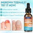 thumbnail image 3 of Ingrown Toenail Removal Kit, Professional Ingrown Toenail Tool Kit Includes Ingrown Toenail Corrector Drops, Corrector Patch, Toenail Clipper, Nail File Lifter Pedicure Tools, 3 of 4