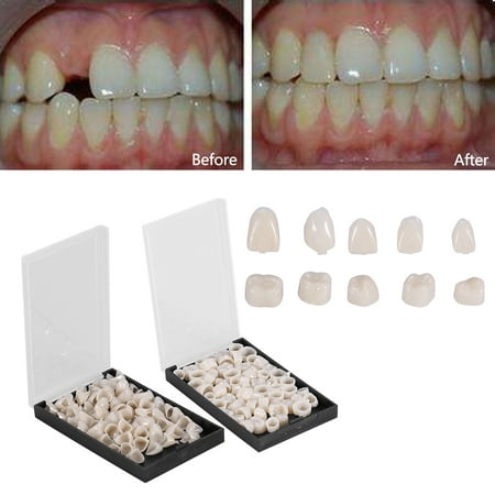 WALFRONT 50Pcs/Box Teeth Crowns, Dental Teeth Temporary Realistic Oral Care Anterior Molar Crown for Front & Back