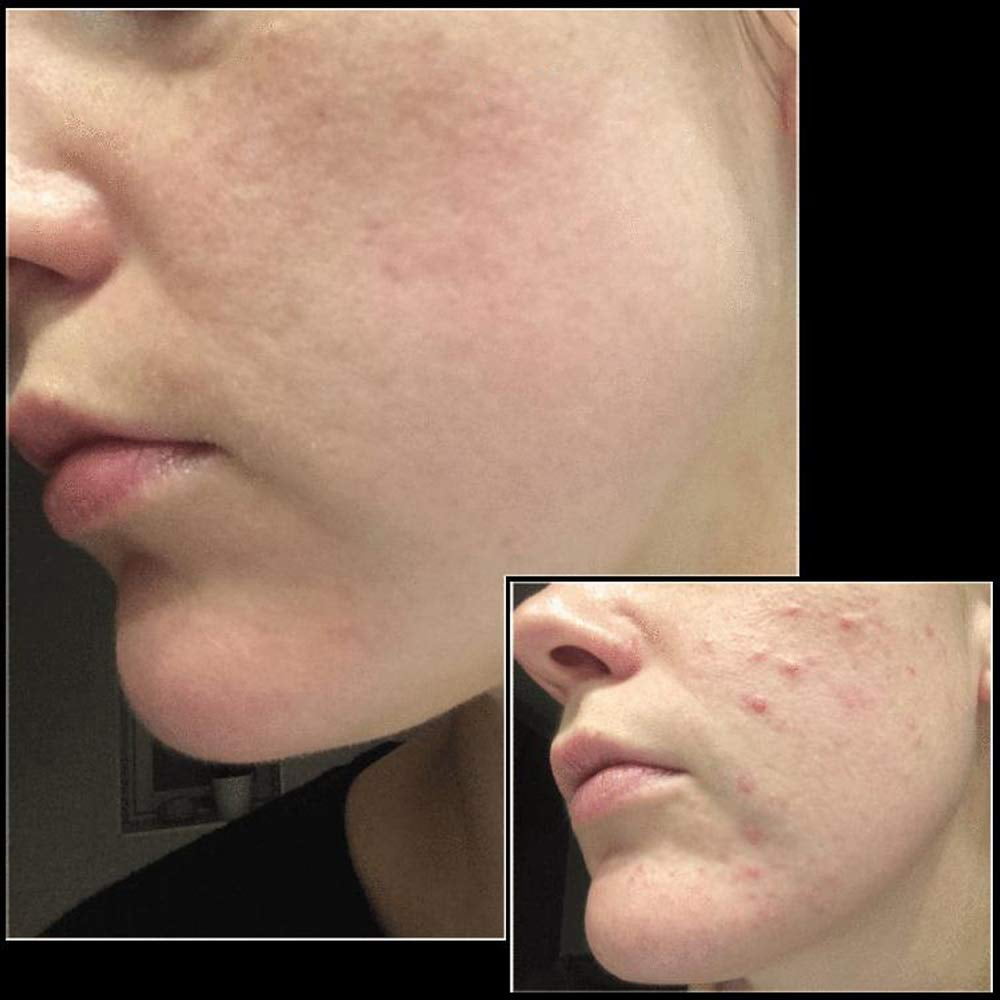 Buy Adjustable Microneedle Derma Stamp for Face Skin Acne Scar Repair