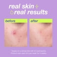 thumbnail image 2 of Liquid Peel Dermalogica Clear Start Breakout Clearing, 30 ml, 2 of 6