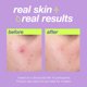 thumbnail image 2 of Liquid Peel Dermalogica Clear Start Breakout Clearing, 30 ml, 2 of 6