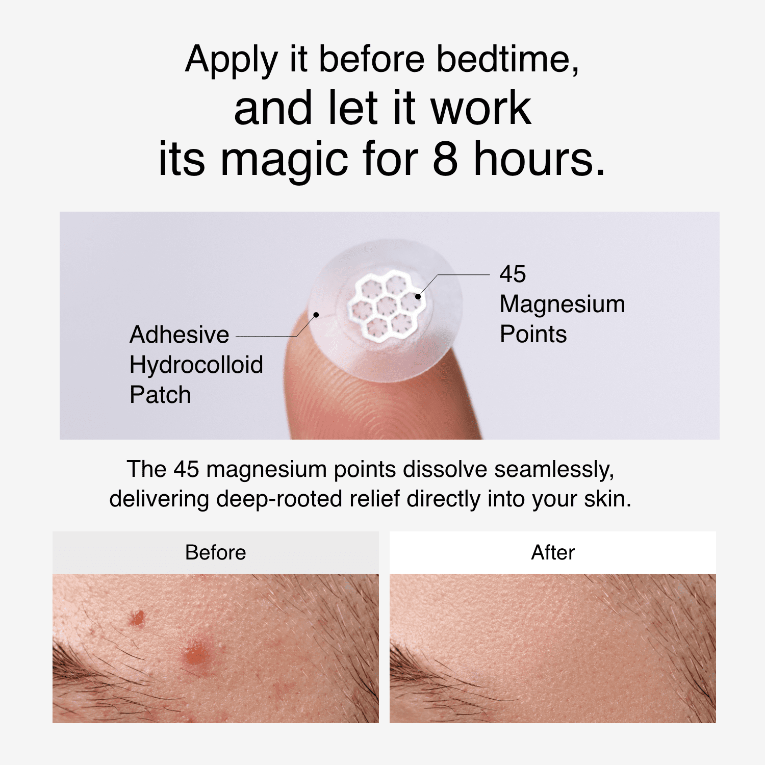 Easyderm Quick Calming Magnesium Hydrocolloid Acne Spot Patches with Cica Ampoule, 20 Count