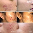 thumbnail image 3 of Sérum Facial Kidskin Z-Blast Salicylic Acid 2% para Preteens y Teens, 3 of 6