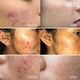 thumbnail image 3 of Sérum Facial Kidskin Z-Blast Salicylic Acid 2% para Preteens y Teens, 3 of 6
