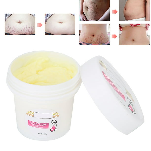 Eliminar las cicatrices del embarazo crema removedor de estrías crema de tratamiento de estrías tratamiento de embarazo maternidad 35g Crema de eliminación de estrías Embarazo ANGGREK Otros