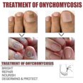 thumbnail image 3 of Nail Treatment Nail Care Manicure And Pedicure Nourishing And Cleansing Removal Of Grey N, 3 of 4