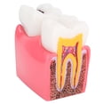 thumbnail image 1 of Modelo de dientes Octpeak Estudio de comparación de caries Saludable, 1 of 7
