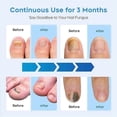 thumbnail image 3 of Nail Fungus Laser Treatment Device Fingernail Fungus Treat Onychomycosis Effectively Remove Onychomy, 3 of 5