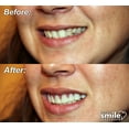 thumbnail image 6 of Instant Smile Makeover Comfort Flex Fit Top Upper Veneers - Natural Shade, 6 of 6