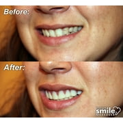 Instant Smile 2-Pack of Natural Shade Makeover Comfort Flex Fit Top Upper Veneer