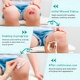 thumbnail image 3 of QARUN Advanced Fast Healing Hydrocolloid Gel Bandages,Hydrocolloid Dressing Roll for Wound Care Bedsore,Burn,Blister,Acne Care,Ultra Absorbent,Waterproof,Diy Size (2In*4.8Ft), 3 of 7