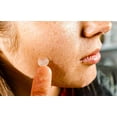 thumbnail image 3 of PDL EMPIRE Micro Needle Acne Patch, 3 of 5