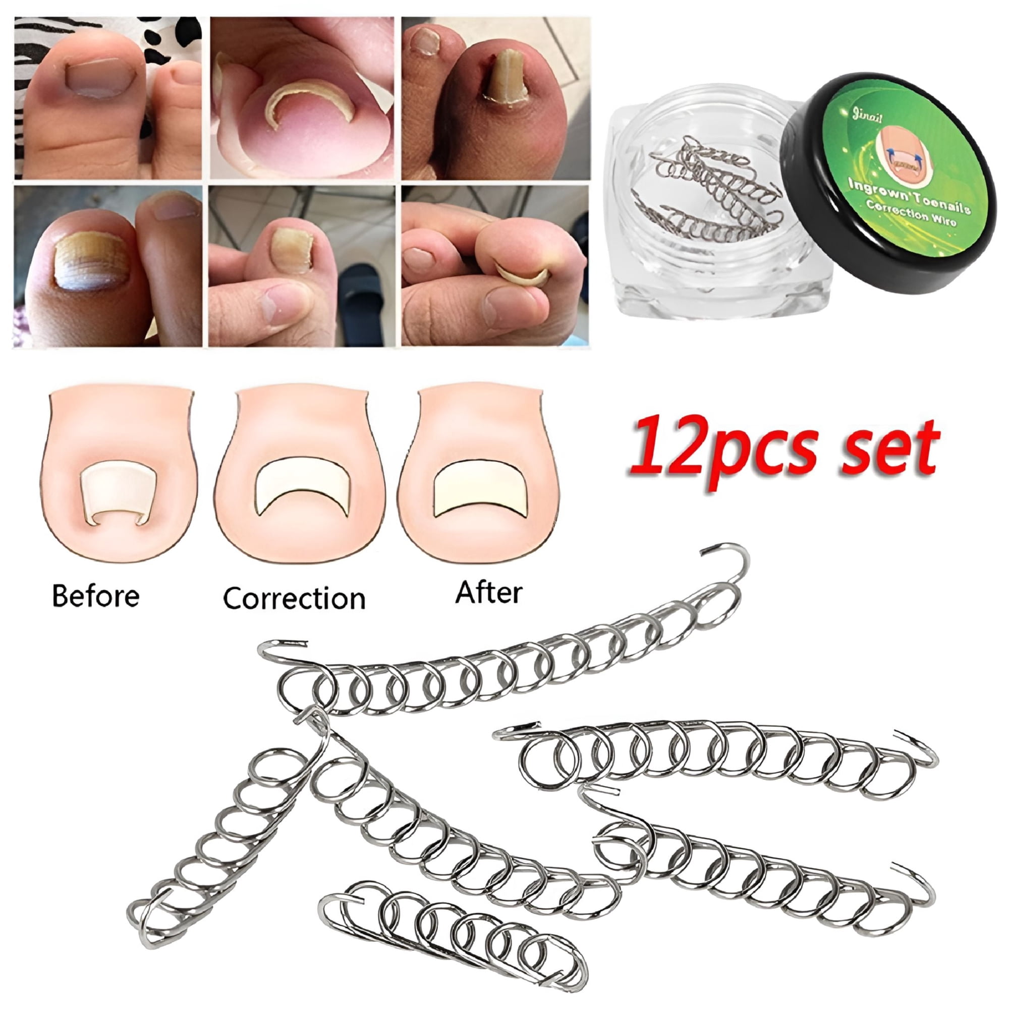 BANIRO Toenail Correction Wire, 6/12Pcs Ingrown Toenail Correction Wire Fixer Foot Care Pedicure Recover Tool