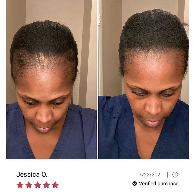 Bald spot deals