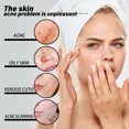 thumbnail image 3 of Suero facial Xihbxyly bioactivo antiacné 10 en 1 30 ml, 3 of 7