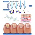 thumbnail image 3 of 2024 2024 New Nail Fungus Laser Device Light Therapy Onychomycosis Toes Treatment Rechargeable New d`, 3 of 4