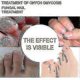 thumbnail image 4 of Spray reparador de uñas grises Elimina las uñas grises Tratamiento para uñas Tratamiento nutritivo para uñas Bright Nail | 8042665686184, 4 of 5
