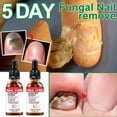 thumbnail image 1 of Nuevo Tratamiento De Hongos En Las Uñas De Los Pies Eliminación Anti Infección Onicomicosis Reparación De Cuidado, 1 of 3