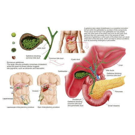 Medical ilustration showing gallstones in the gallbladder and the surgical removal of the gallbladder known as cholecystectomy Poster